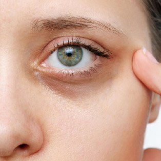 dark circle treatment in bangalore​